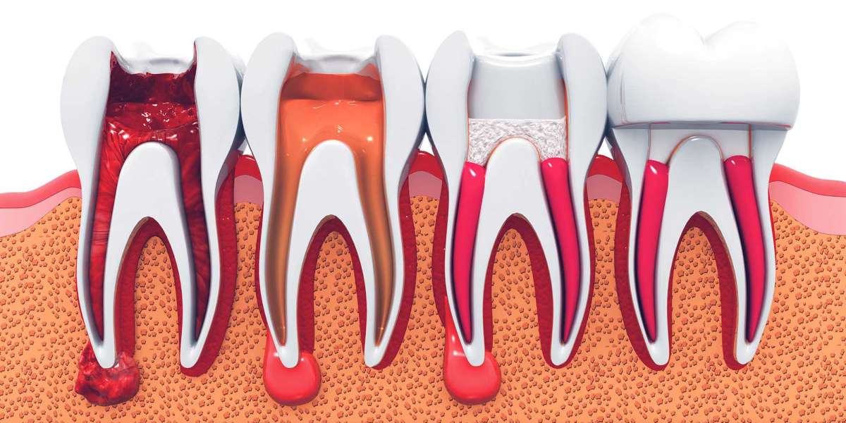 Root Canal - What to Eat and To Avoid After The Treatment