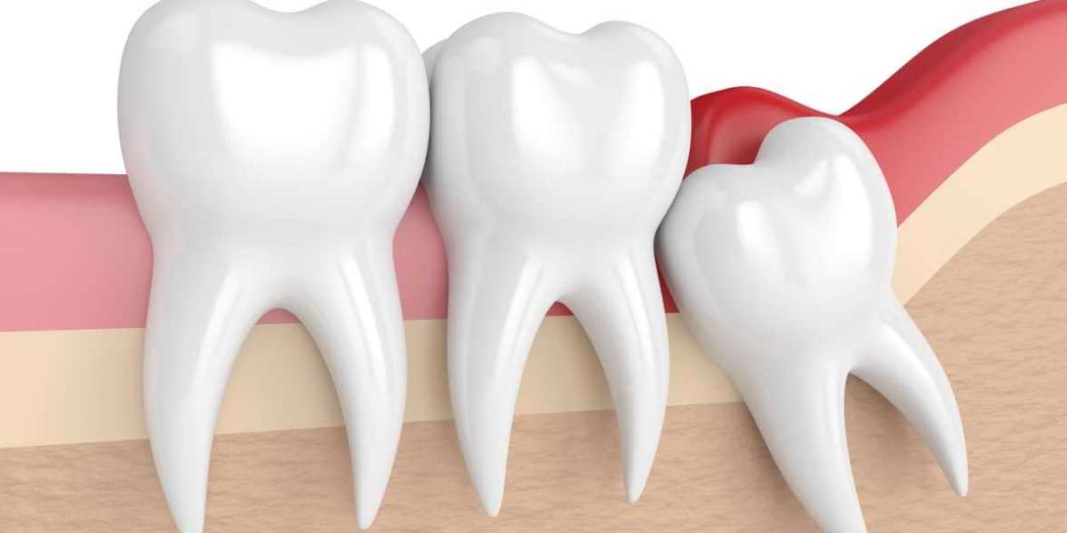 Wisdom Teeth Removal - Here's Everything You Need to Know