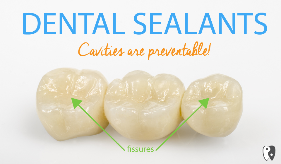 Dental Sealants - Family dentist in castle hills of lewisville Tx - D. Dental