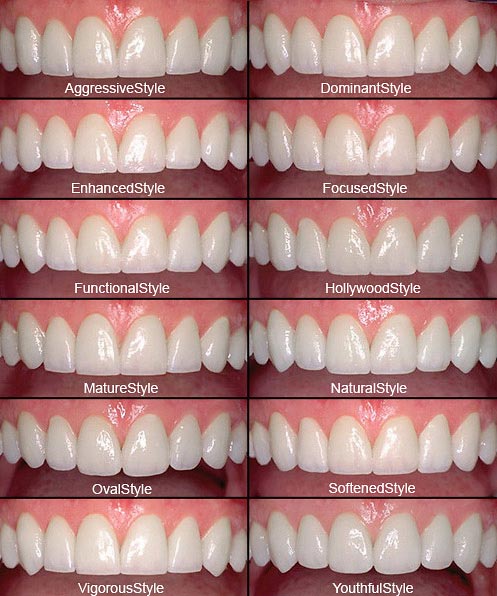 Porcelain Veneers Specialist castle Hills Lewisville TX